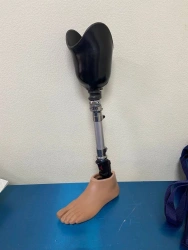 Modular tibial prosthesis, including those with underdevelopment