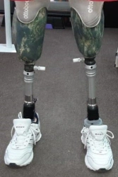 Modular tibial prosthesis, including those with underdevelopment
