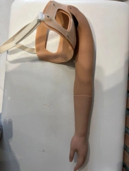 Cosmetic prosthesis after shoulder dislocation