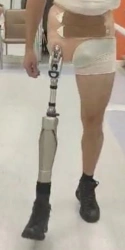 Modular microprocessor-controlled hip dislocation prosthesis